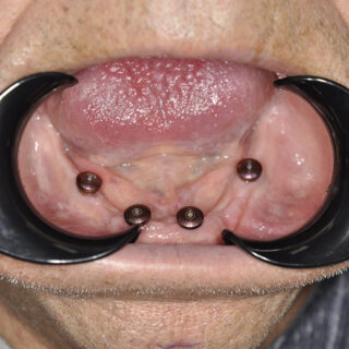 4implants