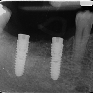 implant