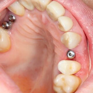implant1