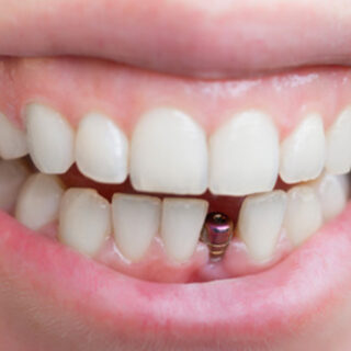 single tooth implant