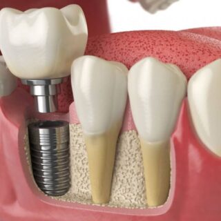 implant3